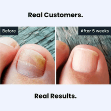 Load image into Gallery viewer, Antifungal treatment pen product image 2